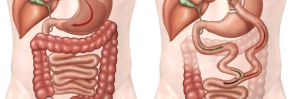 Bypass gástrico: ¿Es realmente necesario?