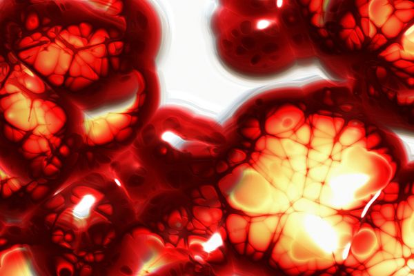 Anemia ¿Tienes una deficiencia de hierro?